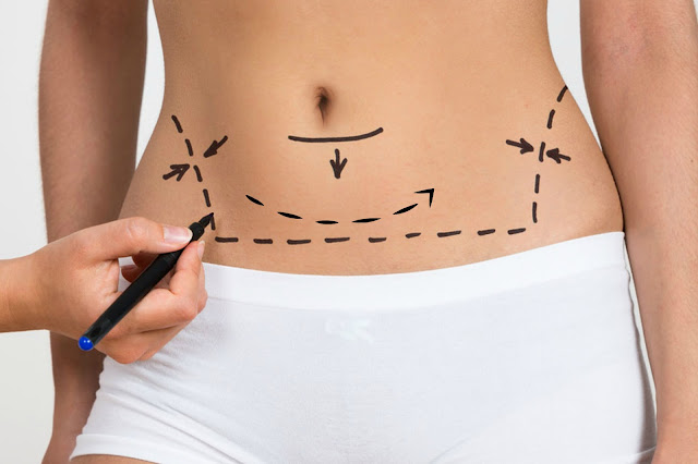 liposuction vs coolsculpting by Barbies Beauty Bits