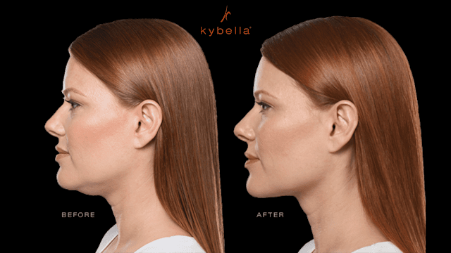 How does kybella work for chin fat By Barbies Beauty Bits