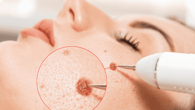 laser-treatments-to-remove-moles-barbies-beauty-bits