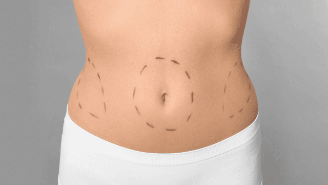 the-benefits-of-combining-tummy-tuck-with-lipo-barbies-beauty-bits